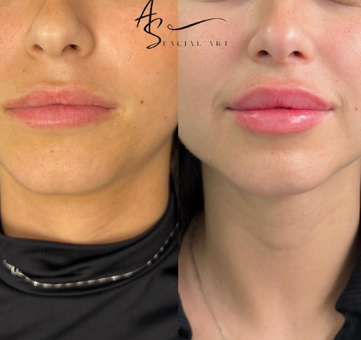 Close-up lip photographs preserving the original AS Facial Art watermark