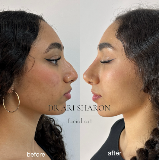 שני צילומי אף מהצד, בכיוונים מנוגדים, עם סימוני לפני ואחרי המקוריים